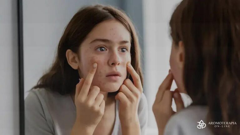 6 Óleos Essenciais Poderosos para Combater Espinhas Naturalmente
